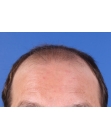 Before Hair Transplant &nbsp;2 Sessions (Areas)